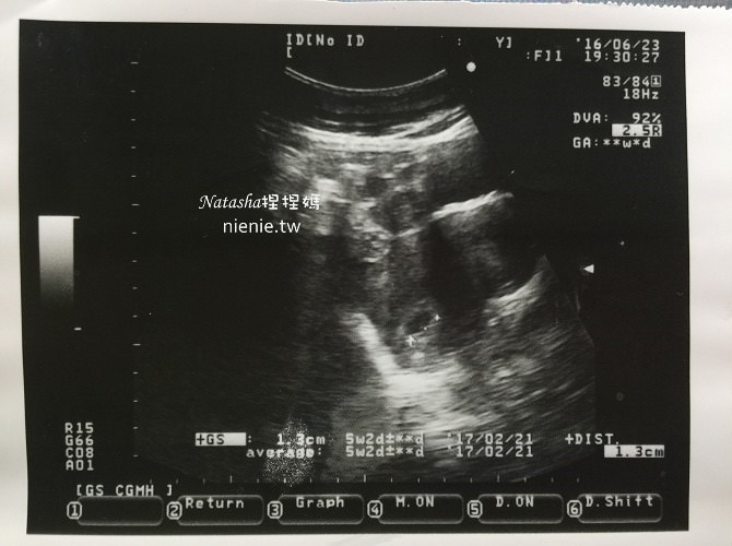 懷孕紀錄│初期0個月~4個月│初唐、子癲前症、早產風險評估~妊娠劇吐症02