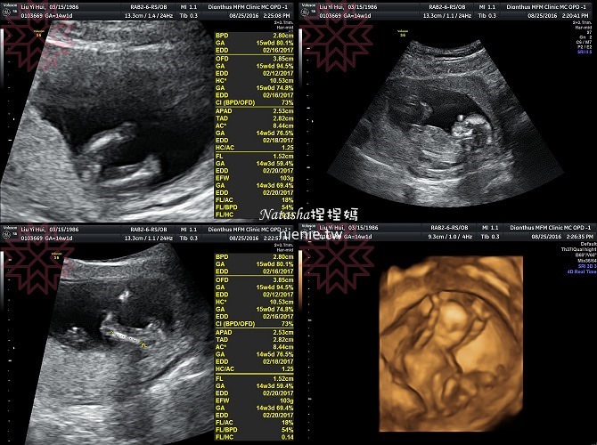 懷孕紀錄│初期0個月~4個月│初唐、子癲前症、早產風險評估~妊娠劇吐症19